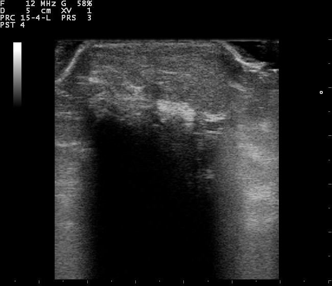 Ultrasound of a subcutaneous lipoma, an oval fatty mass with faint streaks