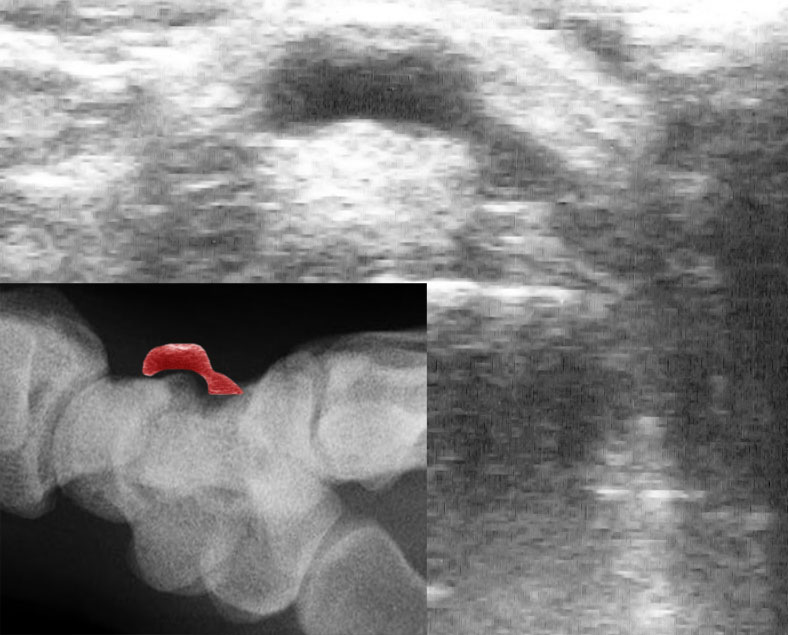 Ultrasound of a ganglion cyst with an inset showing its wrist location