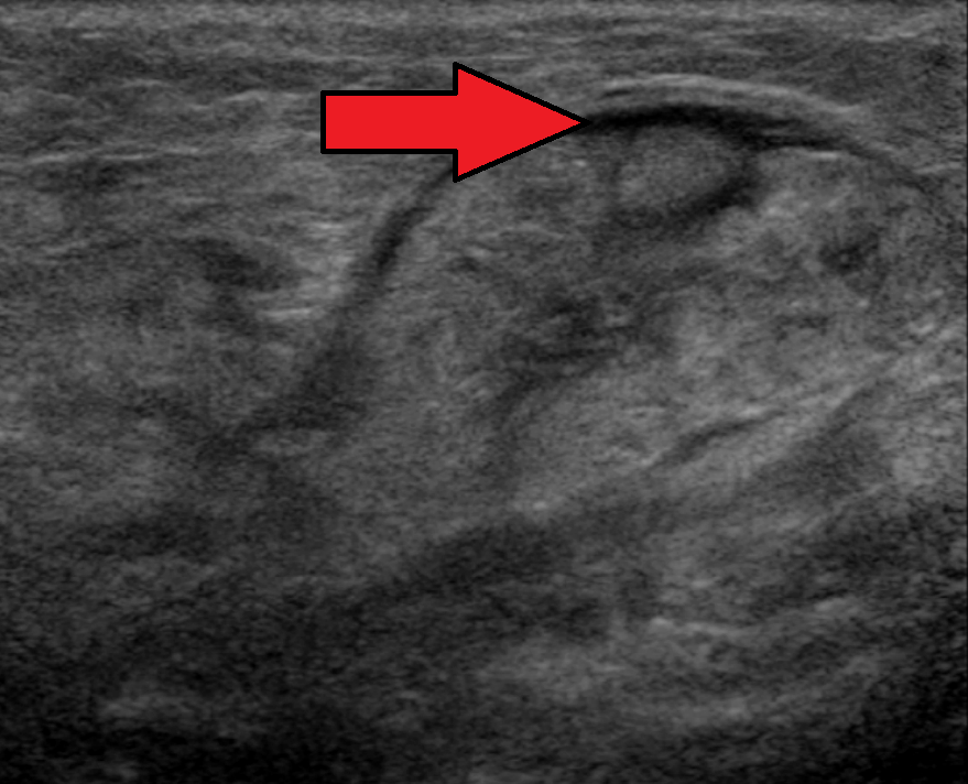 Submandibular salivary gland on ultrasound with an arrow marking an inflamed area