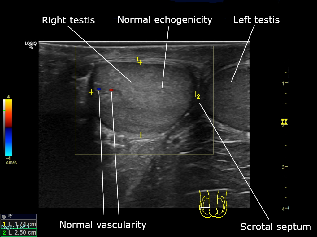 Normal scrotum on ultrasound, both testes with colour Doppler, labelled