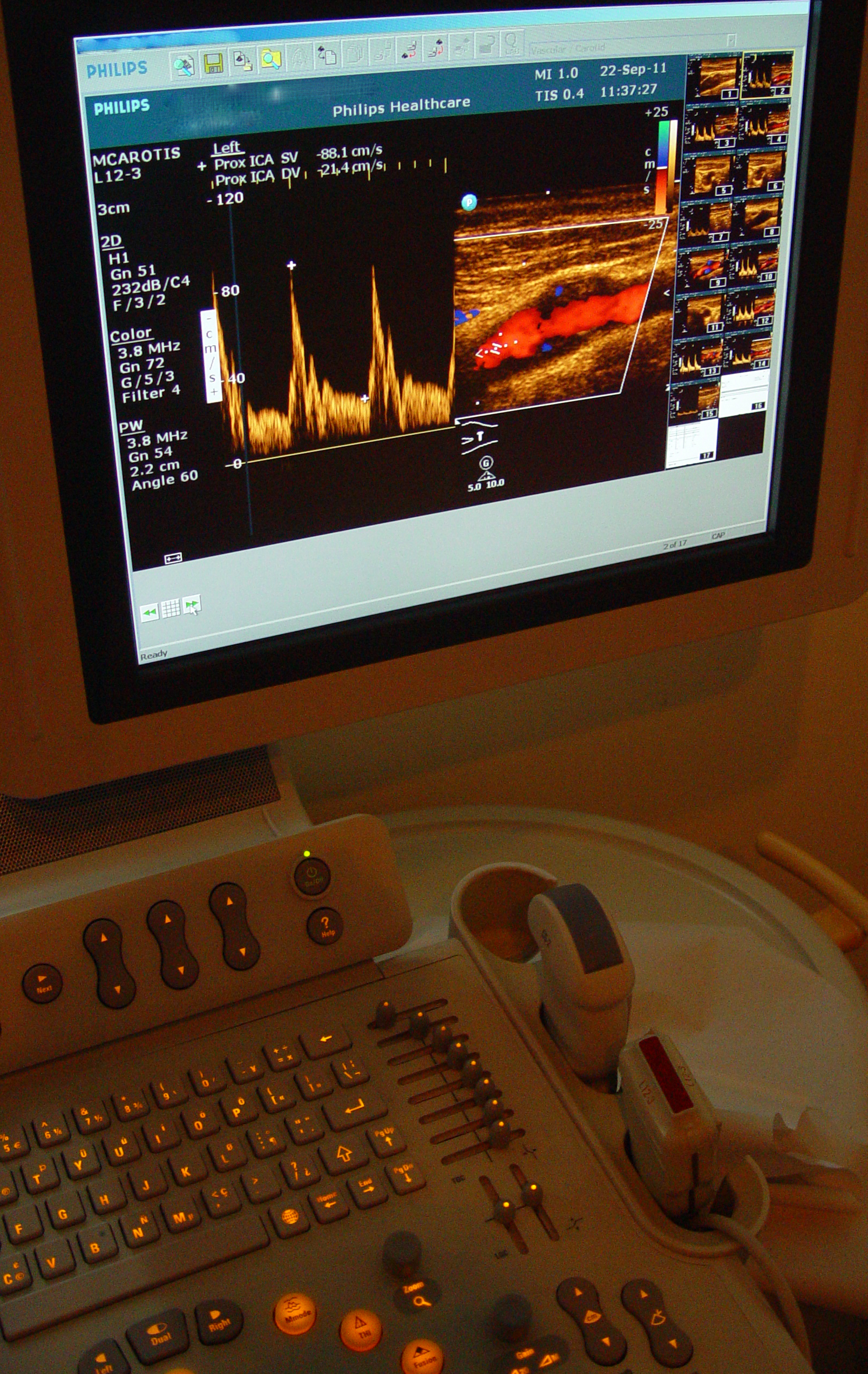 Carotid color and spectral Doppler study on an ultrasound console