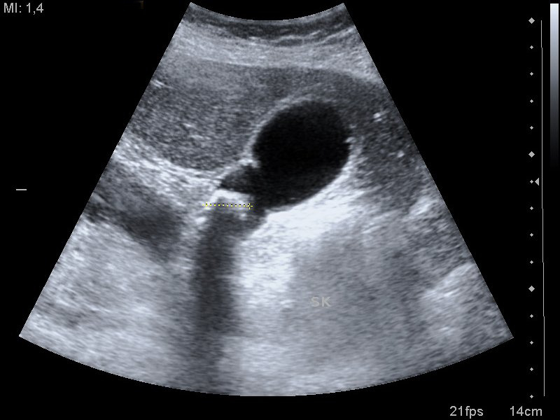 Gallstone with posterior acoustic shadow in a bile-filled gallbladder on ultrasound