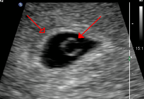Early gestational sac with a yolk sac inside the womb