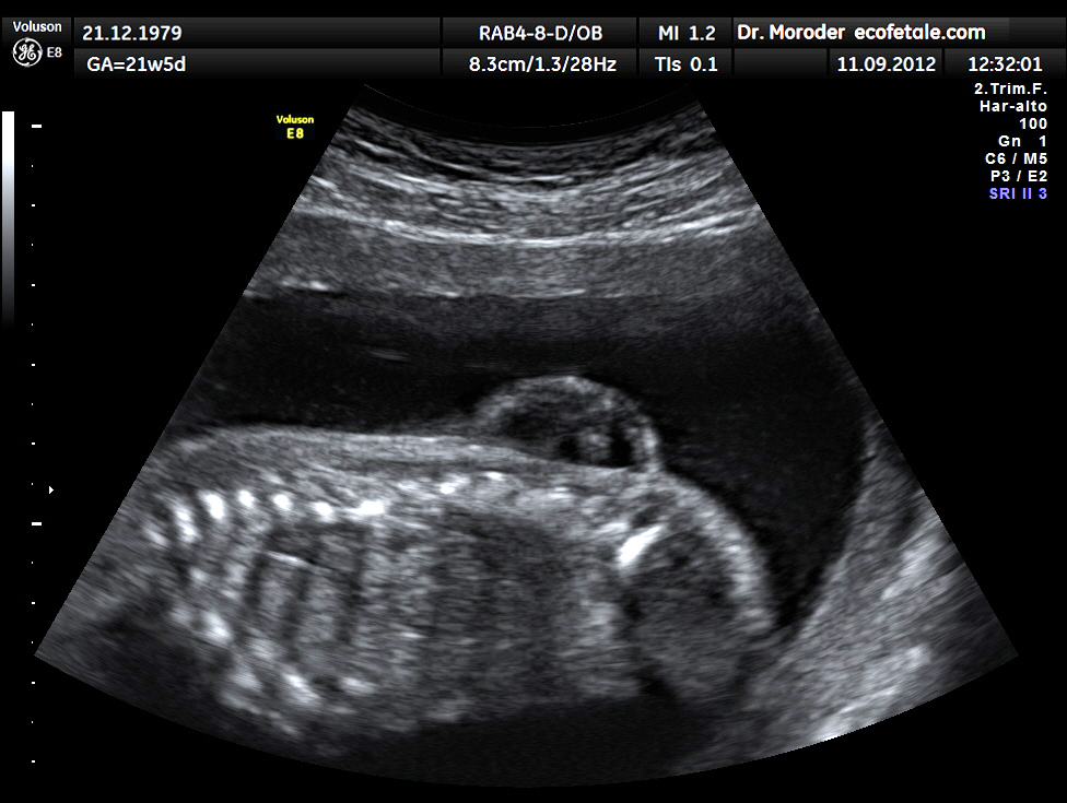 Fetal spine in long section showing a lumbar spina bifida