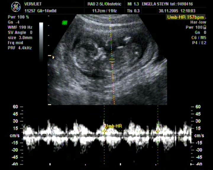 Fetal heart rate on a Doppler trace reading 157 beats per minute