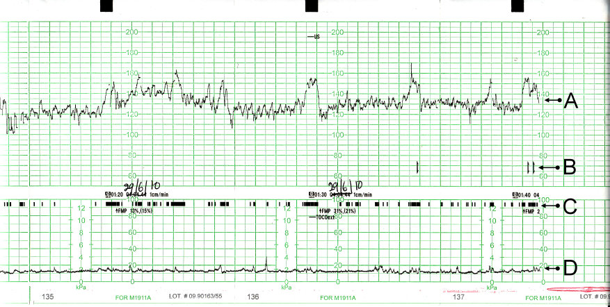 Fetal heart-rate trace on a cardiotocograph showing baseline, variability and accelerations