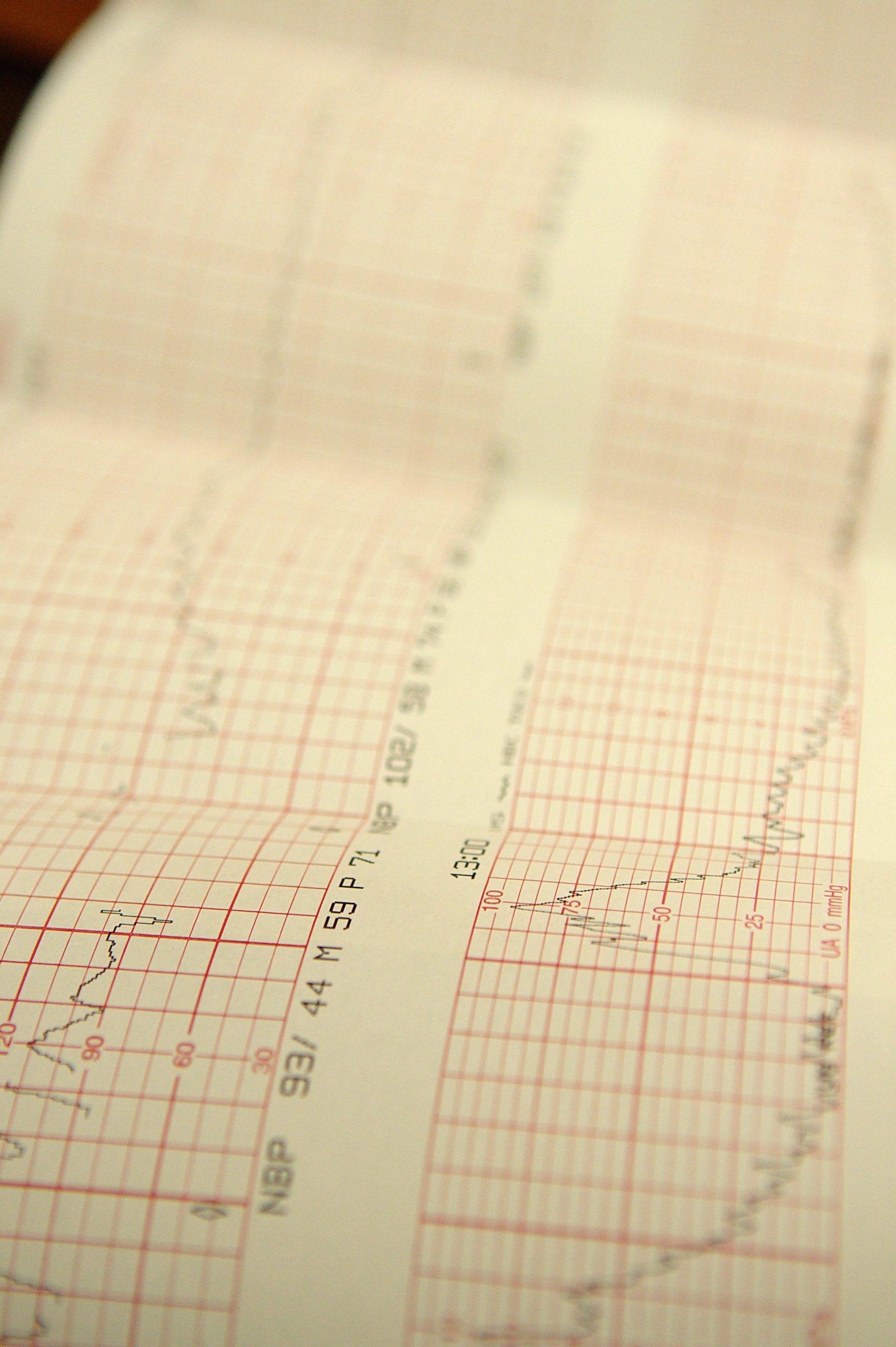Fetal monitoring trace printing on paper during labour