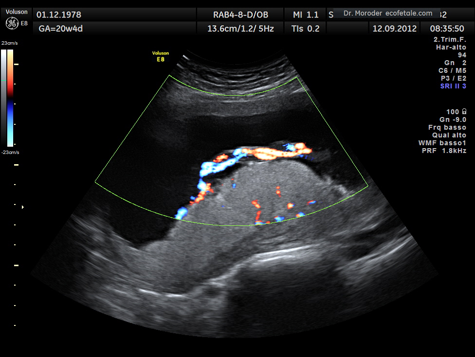 Placenta and umbilical cord on colour Doppler at twenty weeks