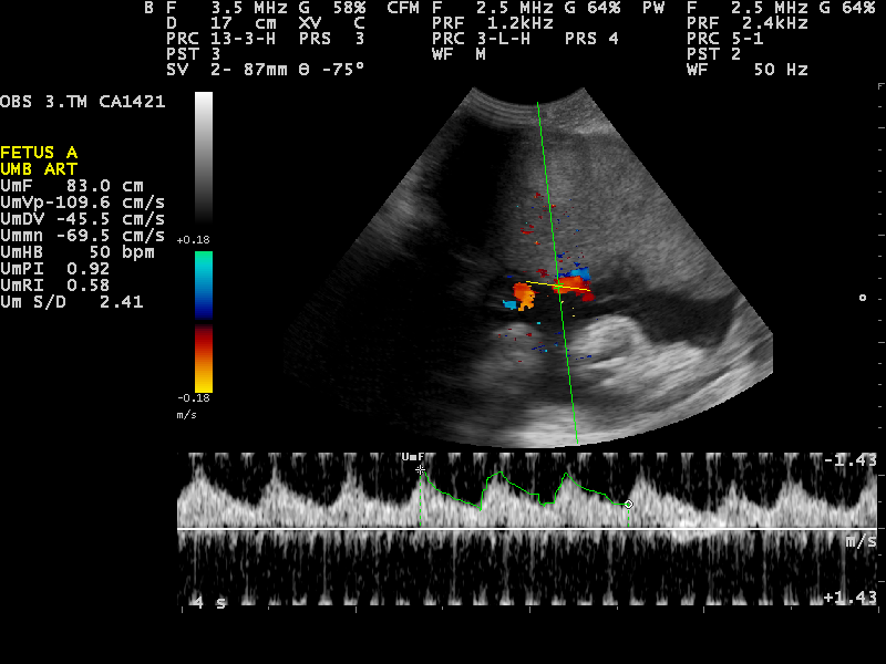 Umbilical artery Doppler with waveform and resistance indices