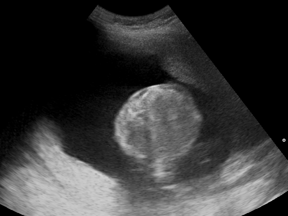 Fetus floating in a dark pool of amniotic fluid