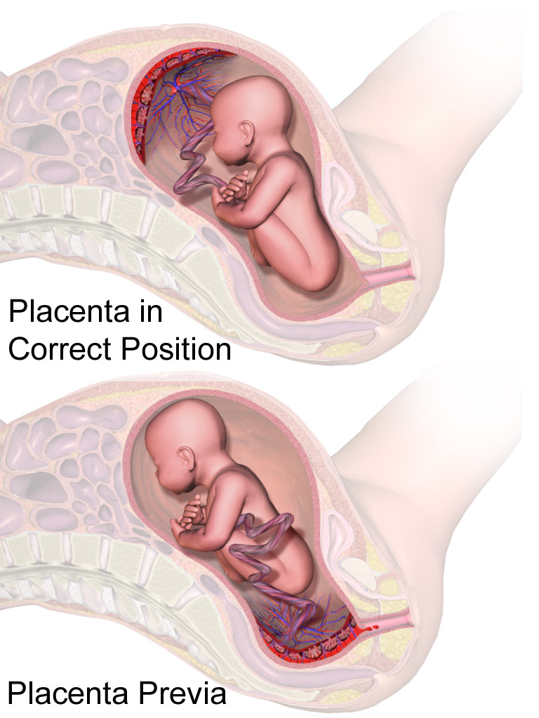 Diagram of a normal placenta position above a placenta praevia over the cervix