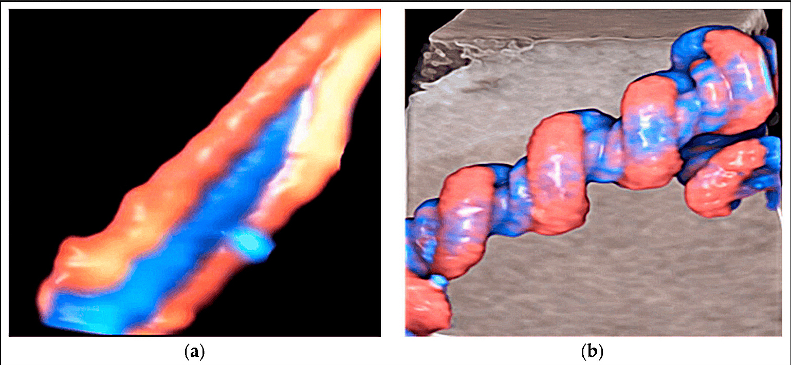 Umbilical cord in colour Doppler, the arteries spiralling around the vein