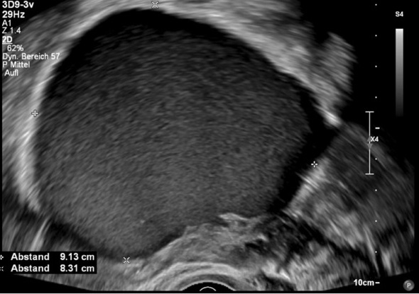 Ultrasound of an endometrioma with an even ground-glass haze, measured about nine centimetres