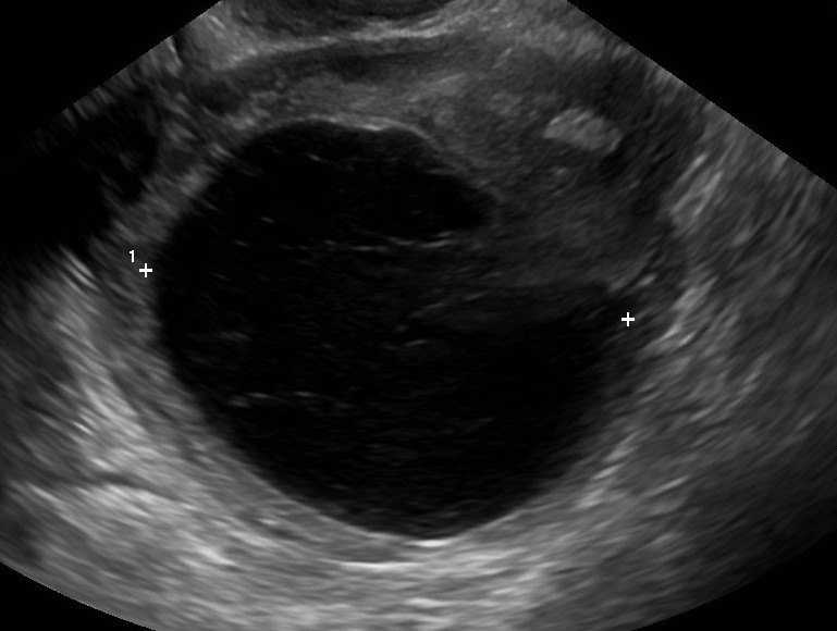 Ultrasound of a large ovarian cyst filled with dark fluid, measured with calipers
