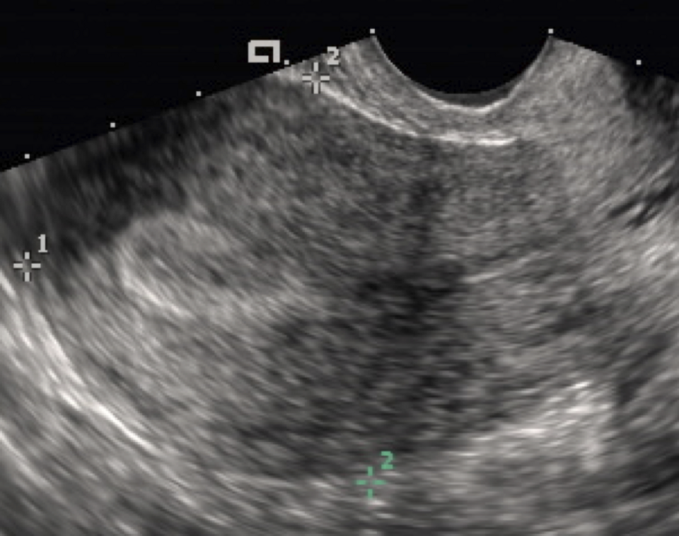 Transvaginal ultrasound of a thick secretory-phase endometrium