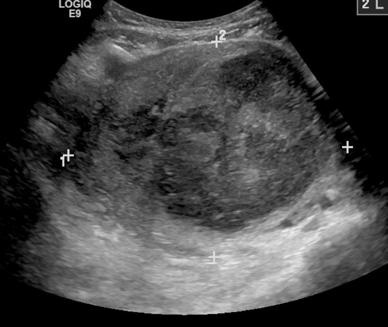 Ultrasound of a large uterine fibroid measured with calipers