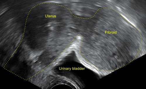 Ultrasound of a subserosal fibroid bulging from the uterus above the bladder