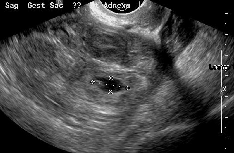 Transvaginal ultrasound of a small gestational sac in the adnexa measured with calipers