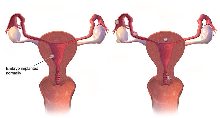 Illustration of where a pregnancy implants, normal in the womb versus ectopic sites