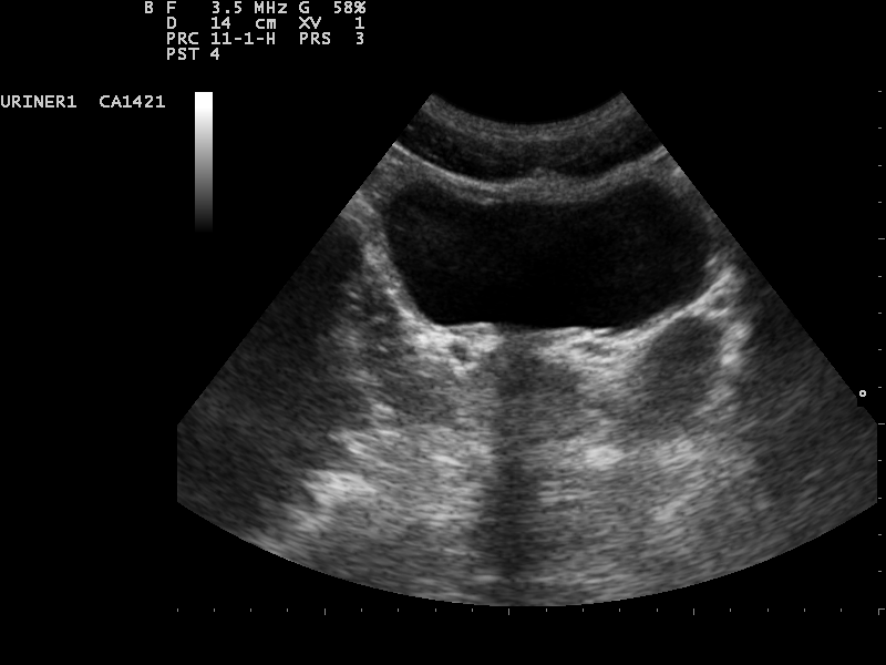 Ultrasound cross-section of a full urinary bladder shown as a dark anechoic pool