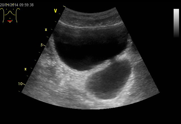 Ultrasound of a bladder with a diverticulum, a rounded pouch budding off the main cavity