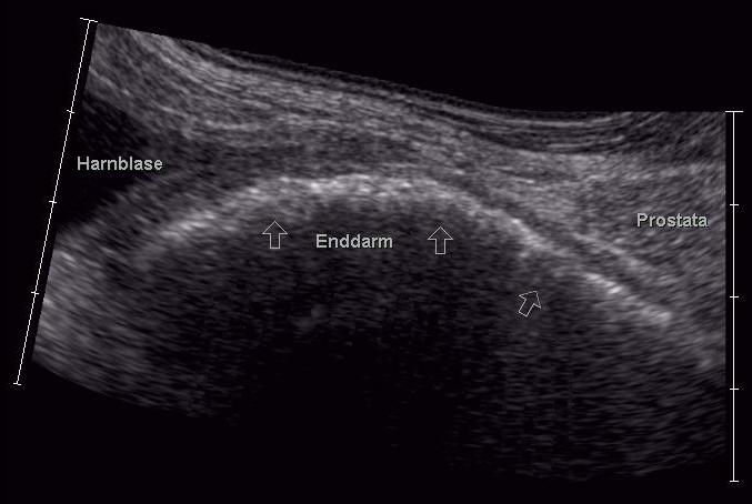 Ultrasound sagittal view showing the bladder and an enlarged prostate at the bladder outlet