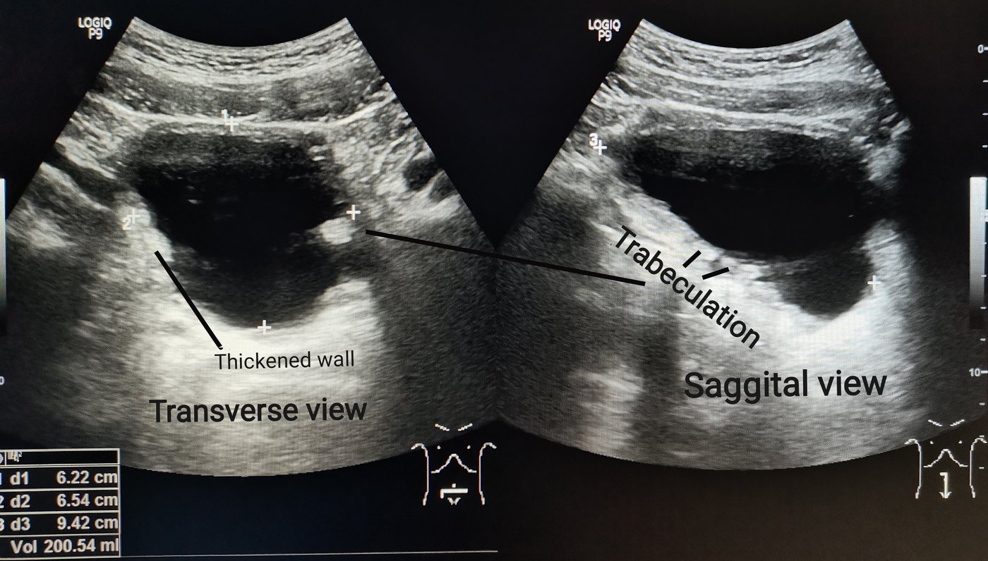 Ultrasound of a thickened, trabeculated bladder wall from chronic obstruction, with a volume measurement