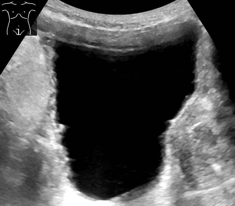 Suprapubic ultrasound of a full bladder with a thickened trabeculated wall