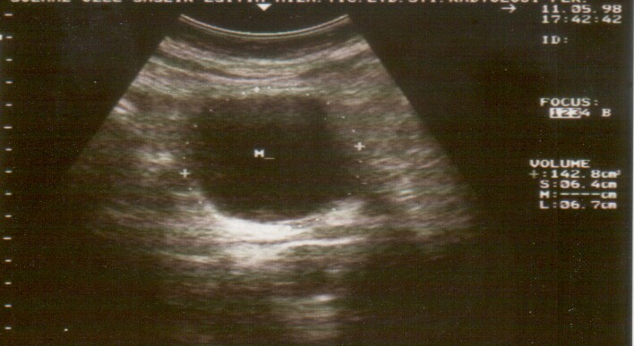 Ultrasound of a urinary bladder with calipers and an on-screen volume readout