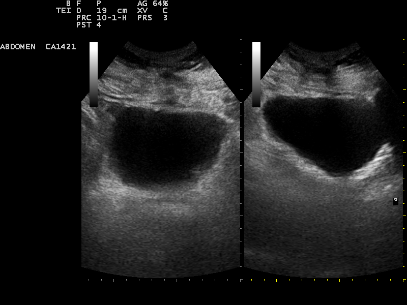 Ultrasound of a full urinary bladder shown as a dark pocket in two views