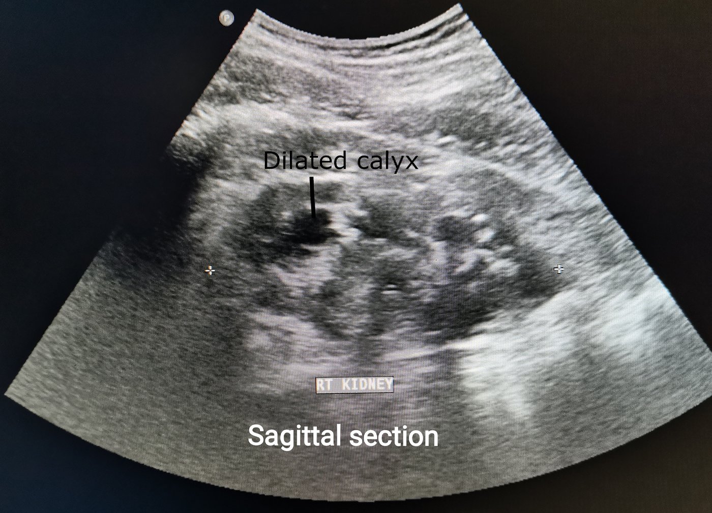 Ultrasound of a kidney with dilated dark calyces, the look of hydronephrosis