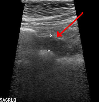 Long-axis ultrasound of the right lower quadrant with a red arrow on the appendix and calipers measuring it at about 12 mm