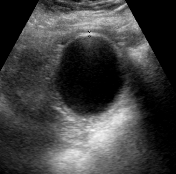 Ultrasound of a gallbladder with calipers measuring mild wall thickening of about 3.5 mm