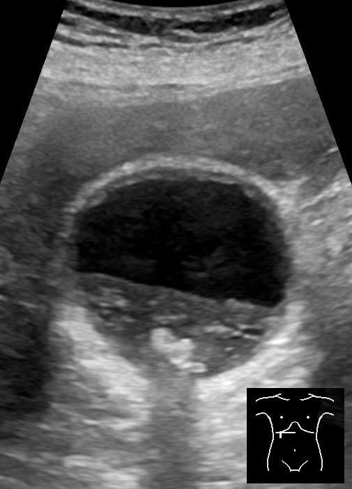 Ultrasound of a gallbladder filled with sludge layering above gallstones casting shadows