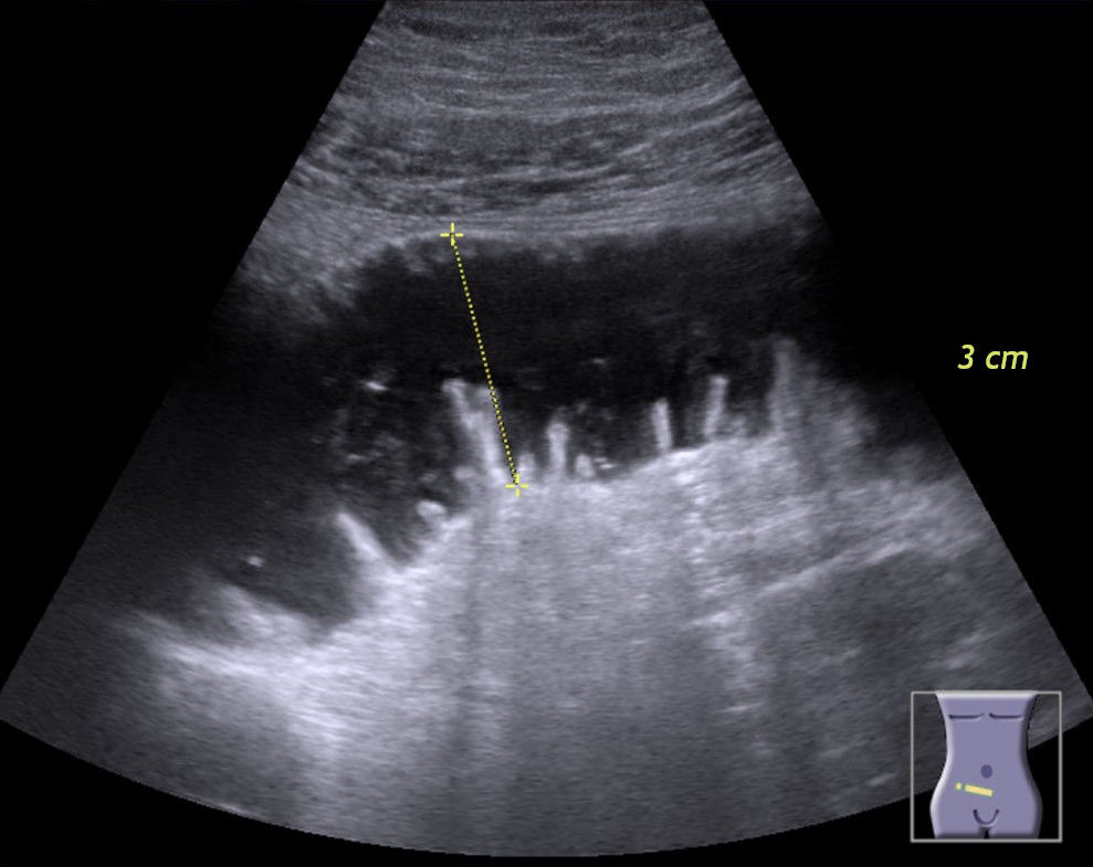 Ultrasound of a dilated small bowel loop measured at about 3 cm with valvulae conniventes, the keyboard sign
