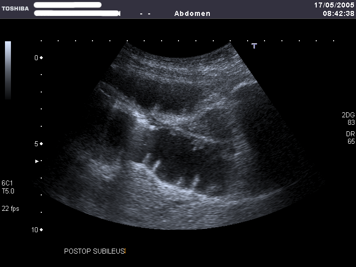 Ultrasound of swollen fluid-filled small bowel loops in a postoperative ileus