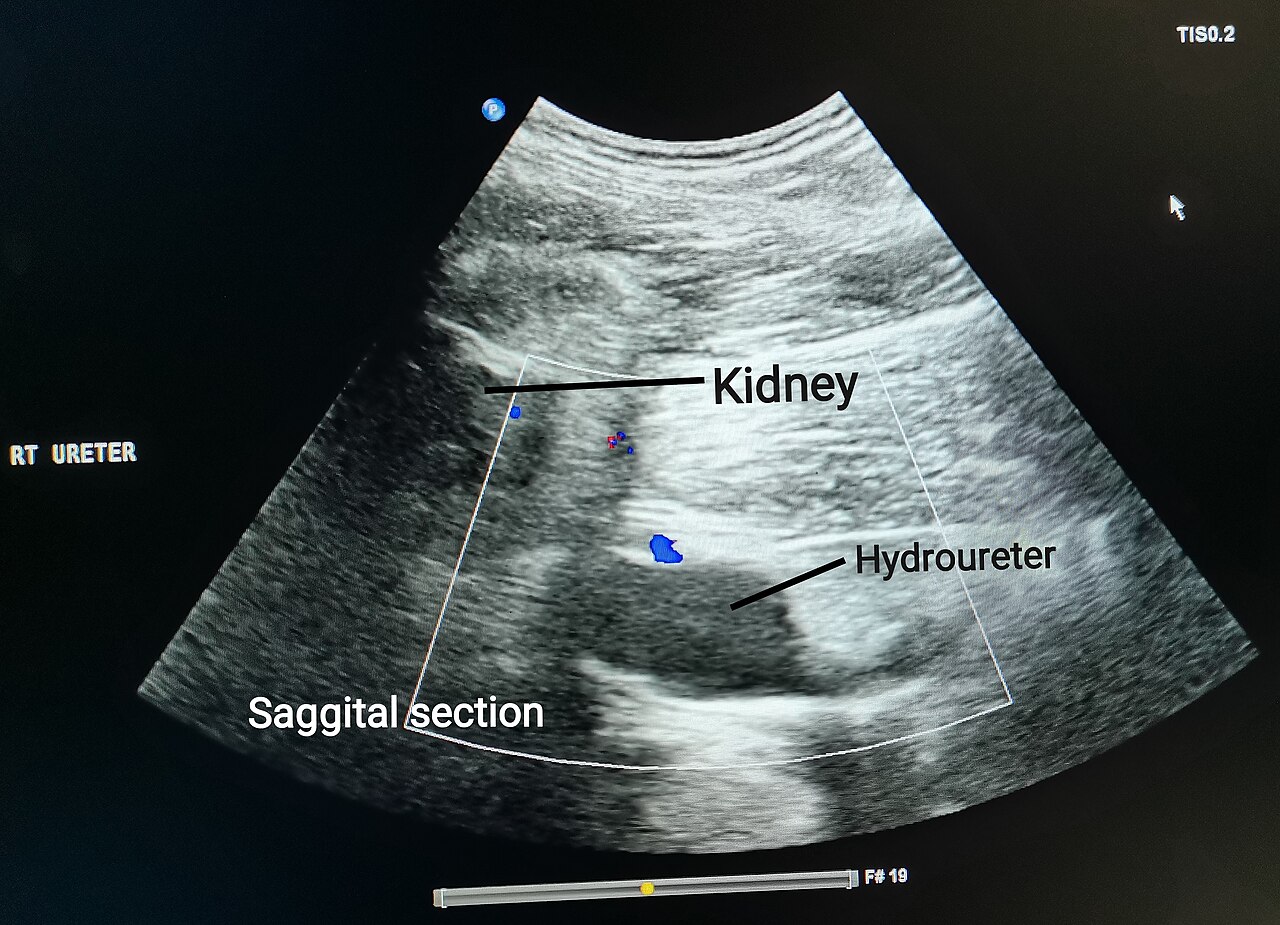 Ultrasound of a kidney with a dilated ureter, hydronephrosis with hydroureter labelled