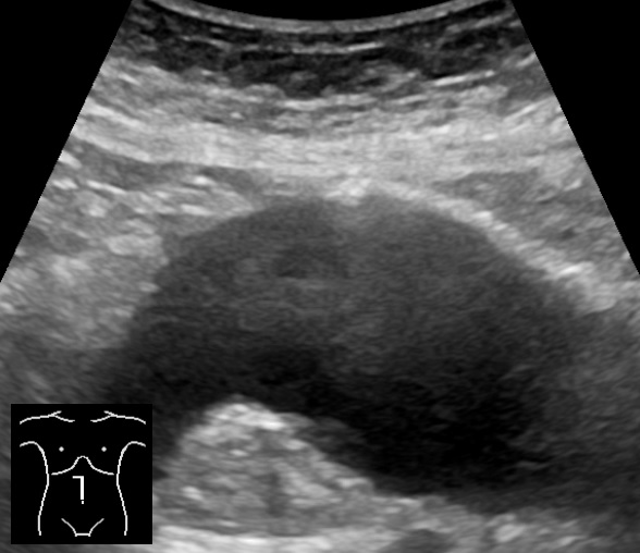 Ultrasound of an abdominal aortic aneurysm in long axis, a wide dark vessel along the spine