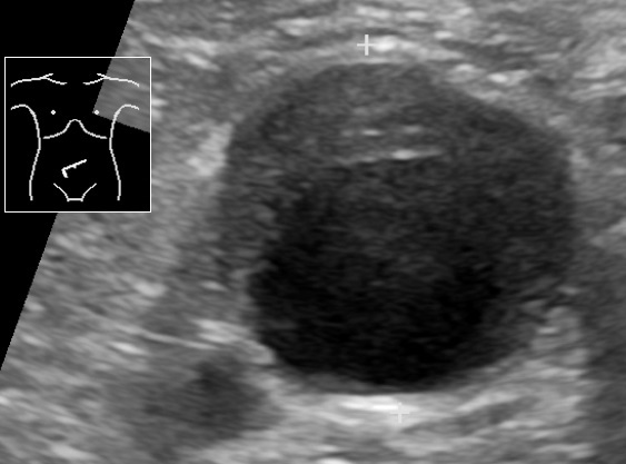Ultrasound of an abdominal aortic aneurysm with mural thrombus, calipers on the width