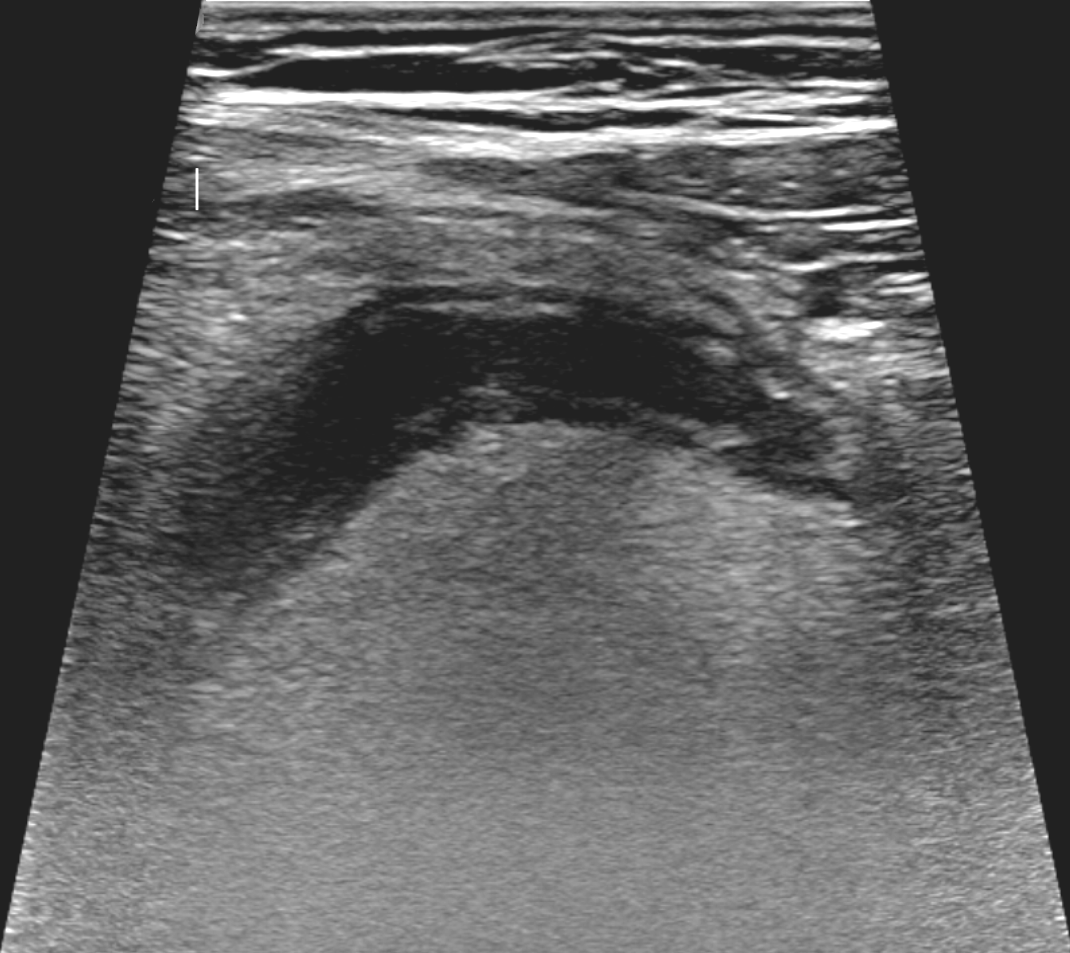 Ultrasound of acute appendicitis, a blind-ending non-compressible tube in the right lower belly