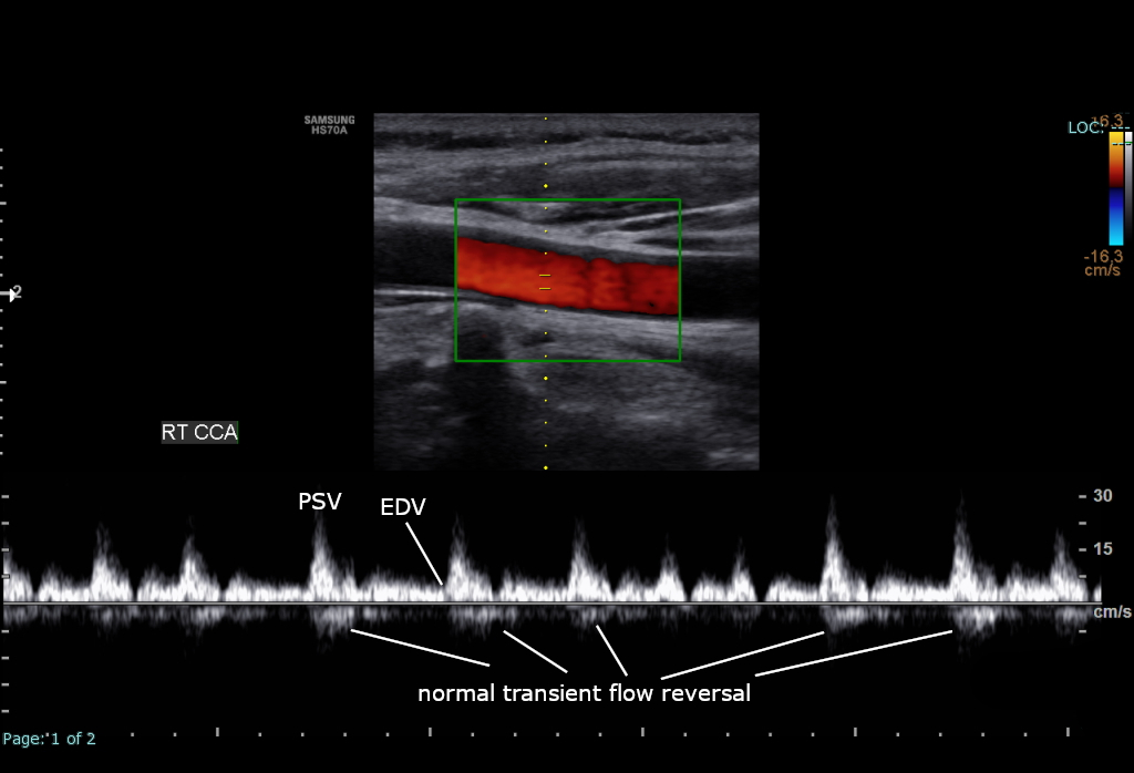 A pulsed-wave spectral Doppler trace of a carotid artery, with the velocity scale at the side.