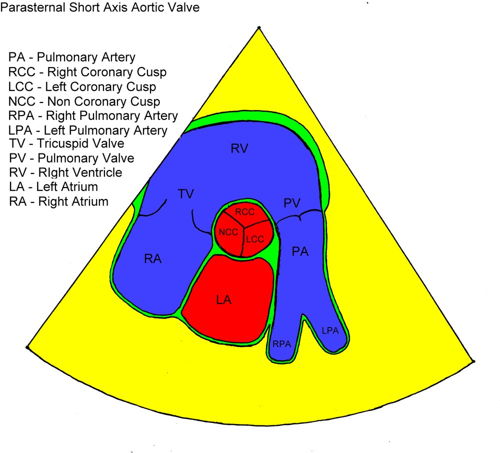A labelled schematic of the parasternal short-axis aortic valve view, naming the three cusps and the surrounding chambers.