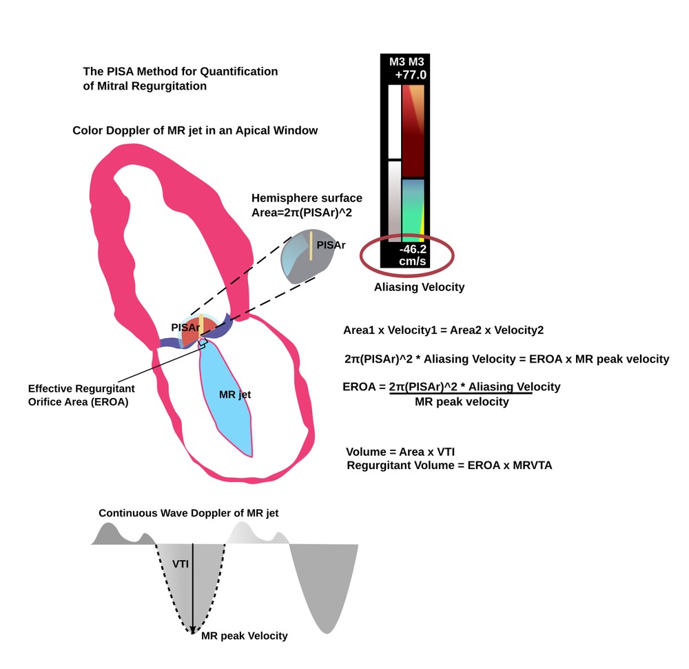 A schematic of the PISA method for quantifying mitral regurgitation, with the hemispheric flow convergence and the formulas.