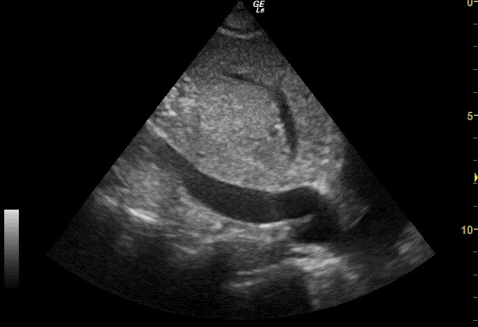 A subcostal ultrasound of the inferior vena cava running below the liver into the right atrium.