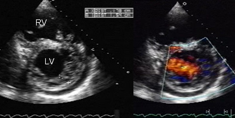 A short-axis echocardiogram, two-dimensional on the left and colour flow on the right.