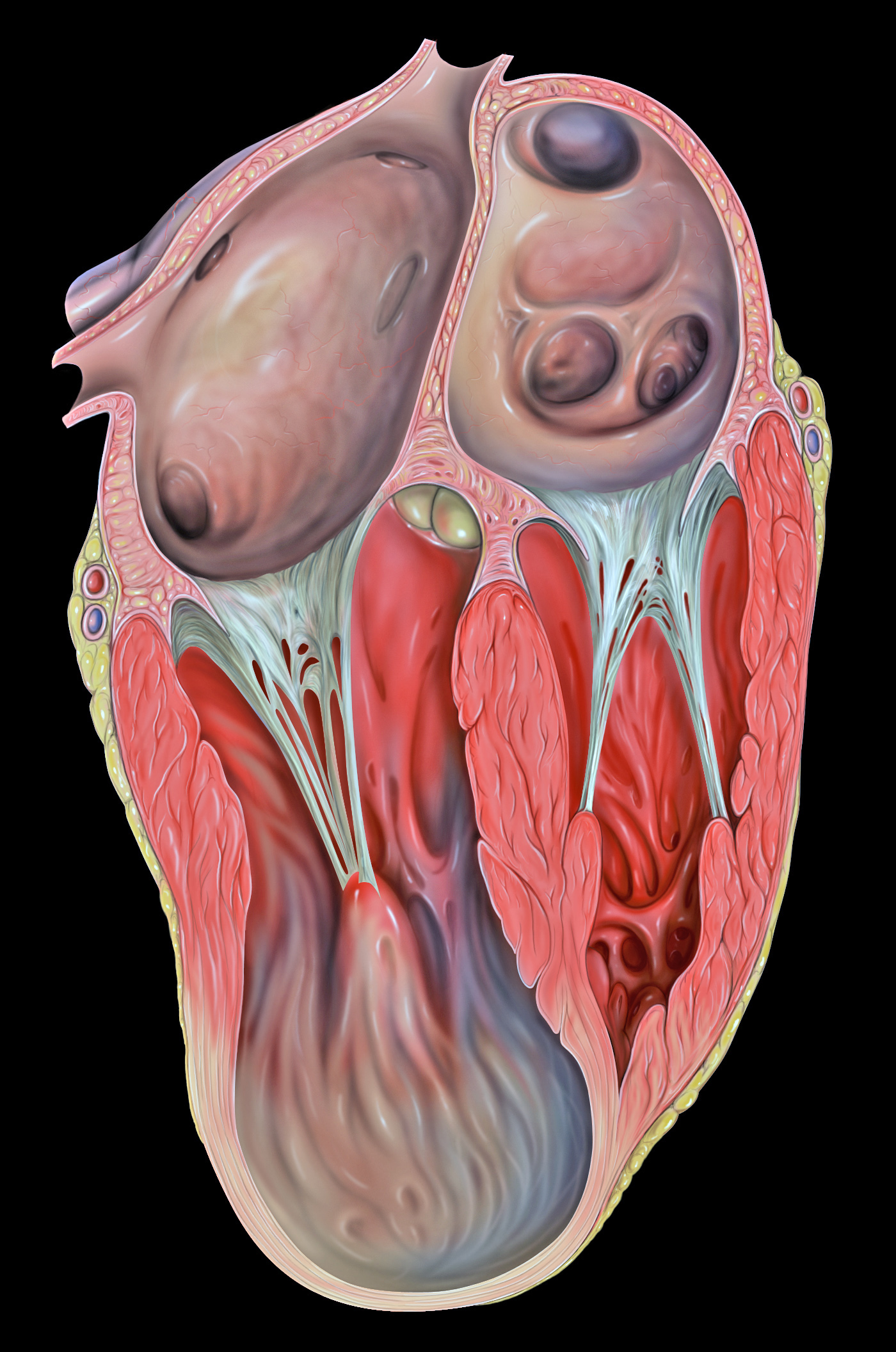 A cutaway drawing of the heart in four chambers, with a thinned bulging apex and dark clots in the upper chambers.