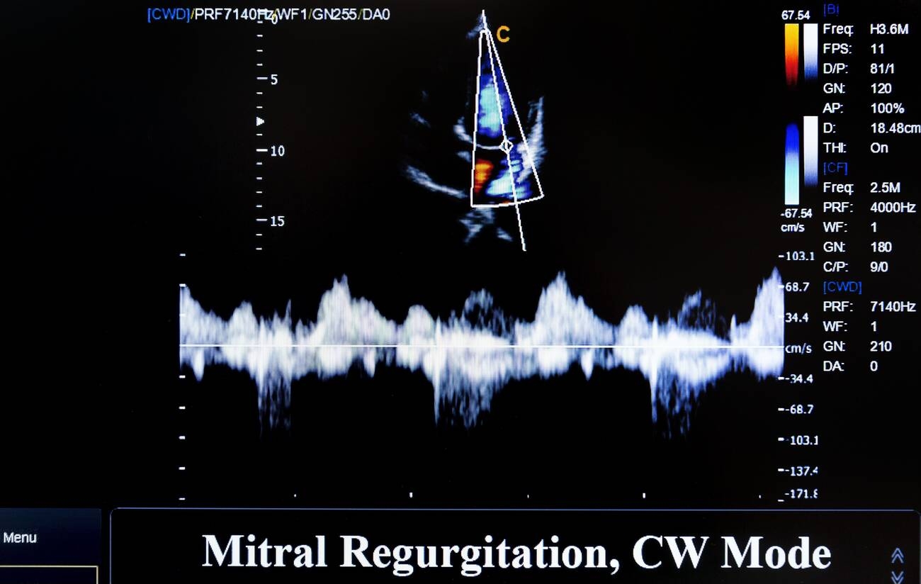 An echocardiogram screen of a mitral leak, with a colour jet, a continuous-wave spectral trace, and the machine settings panel.