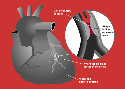 A diagram of a heart attack, a clot blocking a coronary artery and the patch of heart muscle it feeds.