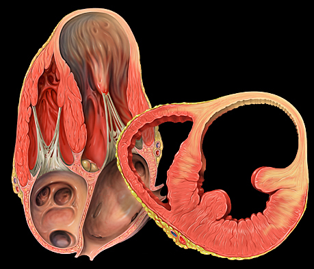 A cutaway drawing of the heart in two views, the thinned apex ballooning out as a left ventricular aneurysm.