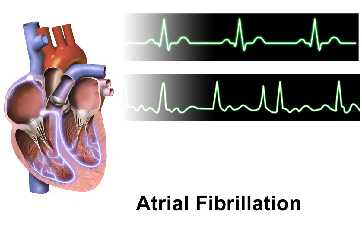 A heart diagram set beside two rhythm tracings, the lower one showing the disorganized beat of atrial fibrillation.